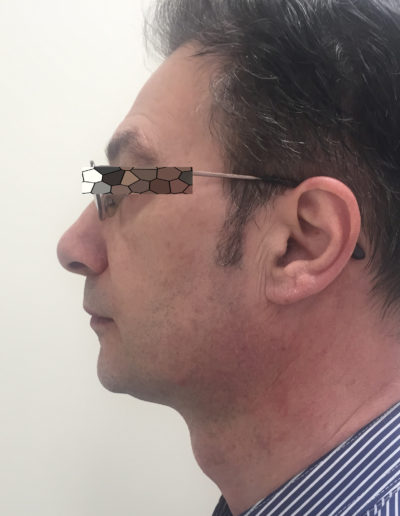 Effetti ultherapy prima e dopo - occhi Effetti ultherapy prima e dopo - occhi
