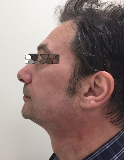 Effetti ultherapy prima e dopo - occhi Effetti ultherapy prima e dopo - occhi