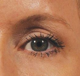Effetti ultherapy prima e dopo - occhi Effetti ultherapy prima e dopo - occhi