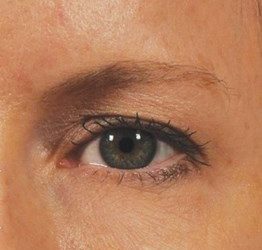 Effetti ultherapy prima e dopo - occhi Effetti ultherapy prima e dopo - occhi