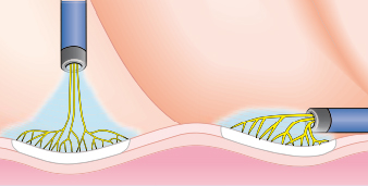 argon decongestione turbinati