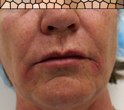 Filler labbra di acido ialuronico Filler labbra di acido ialuronico