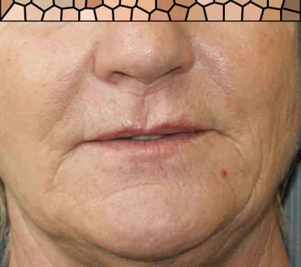Filler labbra di acido ialuronico Filler labbra di acido ialuronico