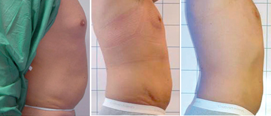 Laserlipolisi - trattamento addome - CMP Pavia Laserlipolisi - trattamento addome - CMP Pavia